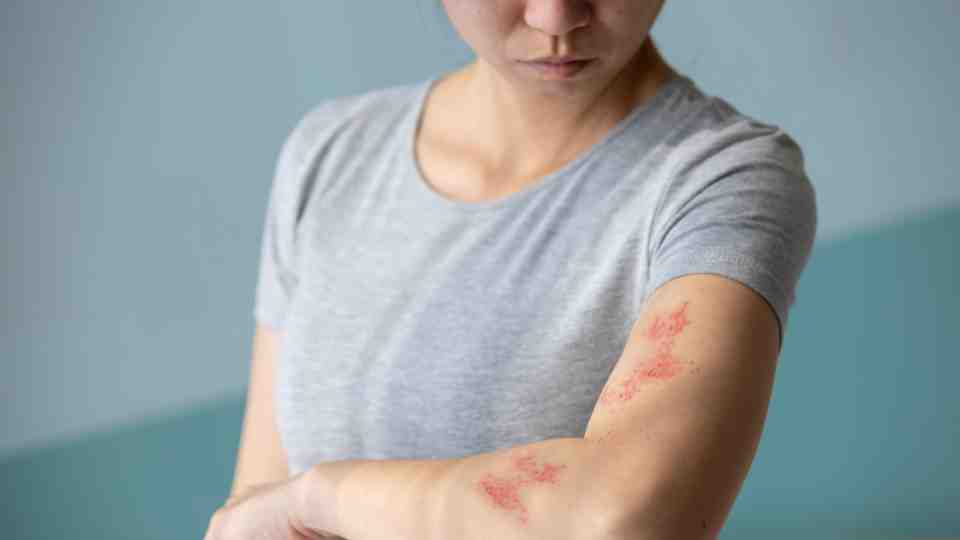 Shingles Treatment in London: A Guide from Junction Pharmacy