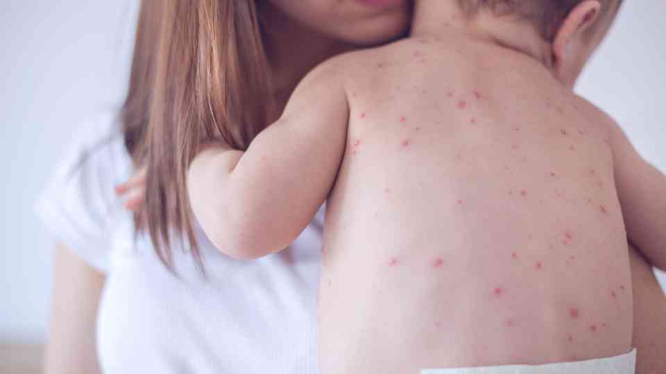 Private chickenpox vaccine