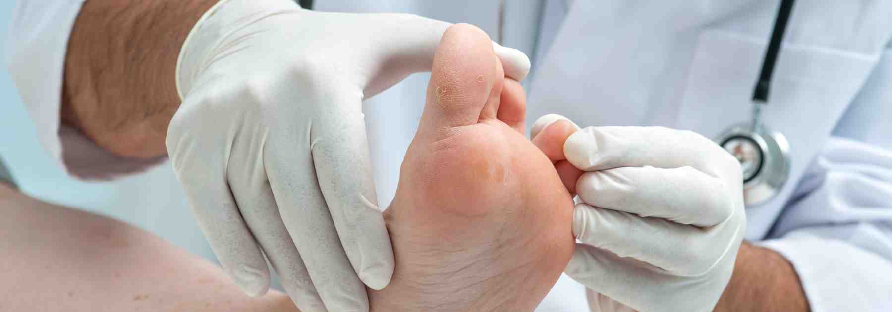 Over-the-counter athlete's foot cream.