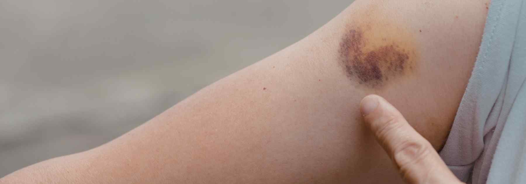 Bruise from injecting Mounjaro