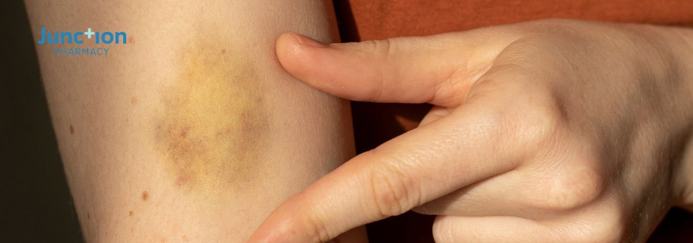 Bruise from injecting GLP-1 medications