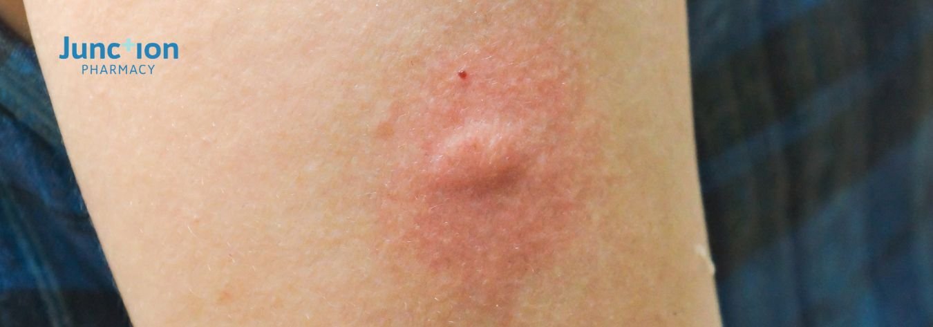 Infected insect bite